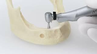 How to Place a Ø4.2x13 mm C1 XD Dental Implant
