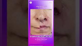 جراحی سانترال لب توسط دکتر میمند متخصص پوست کرج #سانترال_لب #dermatologist  #پوست_زیبا #beauty