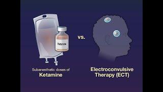 Ketamine vs. ECT for Major Depression  NEJM