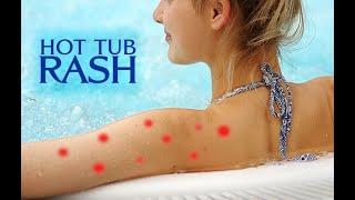 Hot Tub Rash – Causes and Solutions