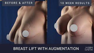 Breast Lift with Augmentation