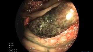 Giant Colonic Angiodysplasia