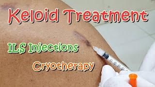 Keloid Scars Treatment ILS Intralesional Steroid Injections Cryotherapy Triamcinolone Acetonide