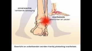 Verstuikte enkel - Wat gebeurt er als je je enkel verstuikt?