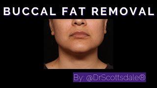 BUCCAL FAT PAD REMOVAL by @DrScottsdale