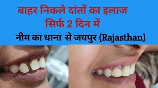 बाहर निकले दांतों का इलाज सिर्फ 2 दिन में Smile design treatment  सामने के दांतों का इलाजsmile