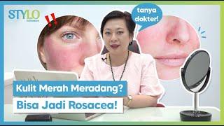 Kulit Wajah Merah Meradang? Bsa jadi Rosacea  Ketahui Faktor Penyebab Rosacea  Stylo