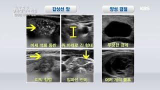 갑상선 혹의 두 얼굴 갑상선 암과 양성 결절 생로병사의 비밀 20200617