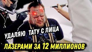 УДАЛЯЮ ТАТУ С ЛИЦА САМЫМ МОЩНЫМ ЛАЗЕРОМ В МИРЕ 