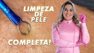 Limpeza de pele completa com extração de cravos.