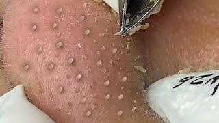 Satisfying With Loan Nguyen Spa Video #061 #acnetreatment