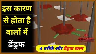 बालों में डैंड्रफ क्यों हो जाता है?  Why does Dandruff occur in hair  रूसी  3D Animation 