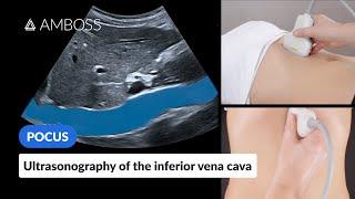 Point of Care Ultrasound of the Inferior Vena Cava IVC - AMBOSS Video