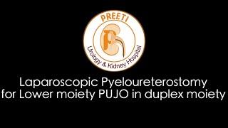 Laparoscopic Pyeloureterostomy for Lower moiety PUJO in duplex moiety