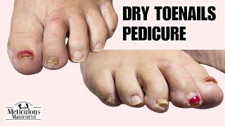 How to Clean Thick Yellow Toenails at Home #nails #satisfying