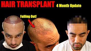 My Hair Transplant Results After 4 Months  Hair Falling Out