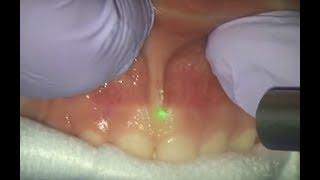 Frenectomy Maxillary with Solea a CO2 9.3 µm All-Tissue Laser