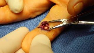 Live Surgery Foreign Body BB Removal from Finger