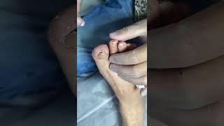 Ingrown toenail removal with Pedicure Knife Cut it easily Ep571