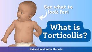 What is Torticollis?