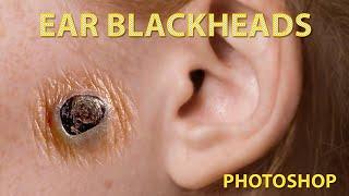 Ear Blackheads Best Ear Pimples at All Time