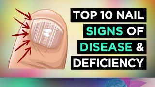 10 NAIL SIGNS of HEALTH PROBLEMS and Nutritional Deficiencies