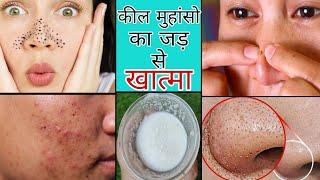 आपकी गाल नाक के सारे BlackheadsWhiteheads एक बार में ख़त्म Skin चमकेगी Open Pores भी नही रहेंगे