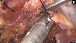 Asvide RHV-oriented laparoscopic parenchyma-sparing anatomical right posterior sectionectomy…