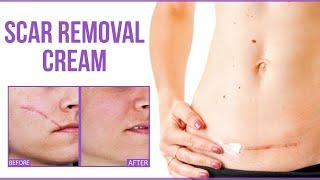 5 Best Scar Removal Cream  Skin Scar Treatment That Actually Works