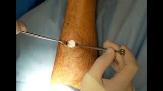 Distal Gastrocnemius Recession - Anatomy and Surgical Procedure.