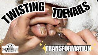 Fix Tight Twisted Toenails Pedicure Tutorial #nails #satisfying