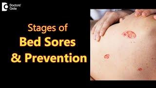 BED SORES DECUBITUS ULCERS Stages Causes Symptoms & Treatment-Dr.Aruna Prasad  Doctors Circle