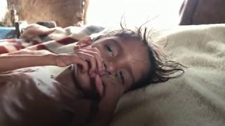 Yemen crisis Five years of hunger five years of war