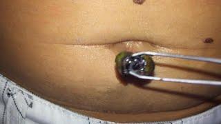 Navel Stones – What Are They and What Causes Them?