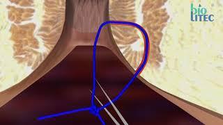 Anal Fistula 2019