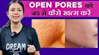 Open Pores का 100% इलाज सिर्फ 15 दिनों में  Home Remedies for Skin  Upasana ki Duniya
