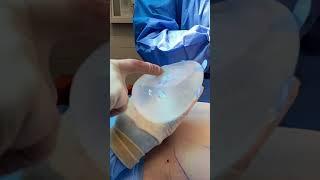 We Dont Use Tissue Expanders During Breast Reconstruction And Heres Why