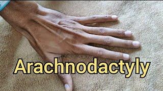 Arachnodactyly in Marfan Syndrome