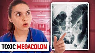 TOXIC MEGACOLON Day in the Life of a Doctor