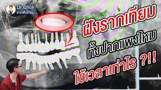 ฝังรากฟันเทียมทั้งปาก แพงไหม ใช้เวลานานหรือป่าว?  คลายปัญหารากฟันเทียมกับหมอโชค