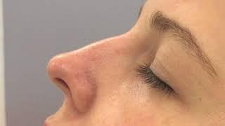 Nonsurgical nose job liquid rhinoplasty using filler by Dr. Shaun Patel  Miami FL