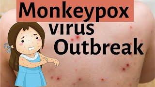 Monkeypox virus outbreak  What is monkeypox virus?