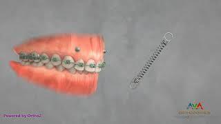 Orthodontic Treatment for Gummy Smile - TAD and Coil Spring