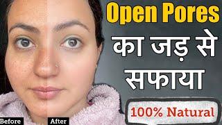 OPEN PORES *खुले रोमछिद्रों* Large PoresClogged Pores Treatment at Home  100% Crystal Clear Skin