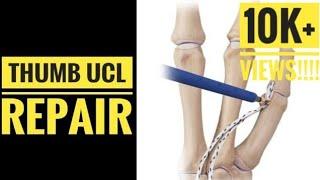 Thumb UCL Ulnar Collateral Ligament Repair with Suture Anchor