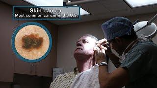 Mayo Clinic Minute 3 Types of skin cancer