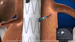 fEVAR Aortic Aneurysm Treatment with Robotics