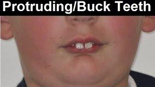 What Causes Protruded Teeth Buck Teeth Frontal Teeth Tipping Forward by Dr Mike Mew