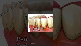 Periodontitis and Laser Hardening Surgery 3D Animation