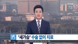 대전MBC뉴스새가슴 수술 대신 교정··완치율 90%